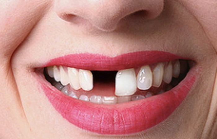 佐賀市の歯医者、池田歯科こども歯科で歯周病治療