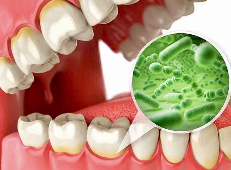 佐賀市の歯医者、池田歯科こども歯科で歯周病治療