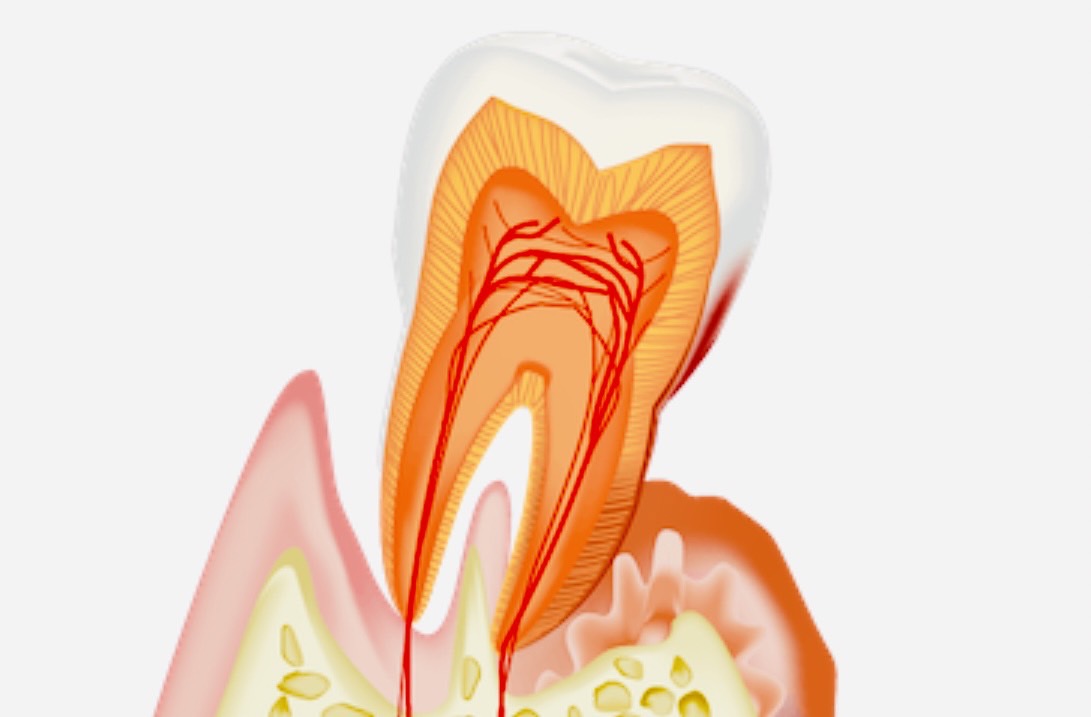 佐賀市の歯医者、池田歯科こども歯科で歯周病治療
