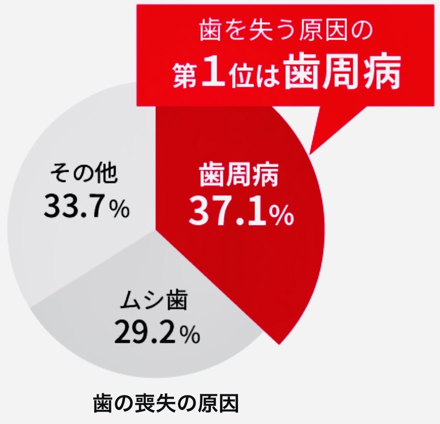 佐賀市の歯医者、池田歯科こども歯科で歯周病治療