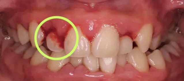 佐賀市の歯医者、池田歯科こども歯科で歯周病治療