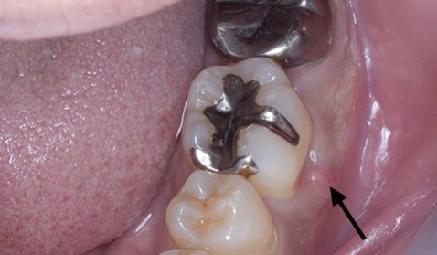 佐賀市の歯医者、池田歯科こども歯科で歯周病治療