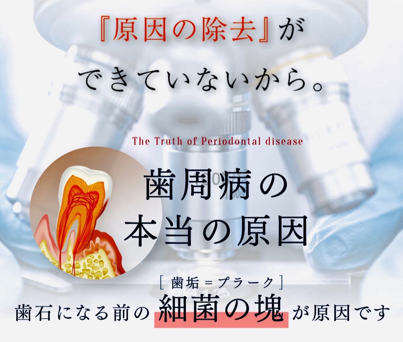 佐賀市の歯医者、池田歯科こども歯科で歯周病治療