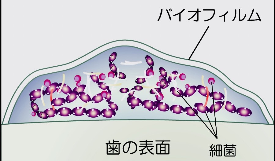 佐賀市の歯医者、池田歯科こども歯科で歯周病治療