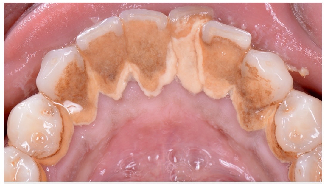 佐賀市の歯医者、池田歯科こども歯科で歯周病治療