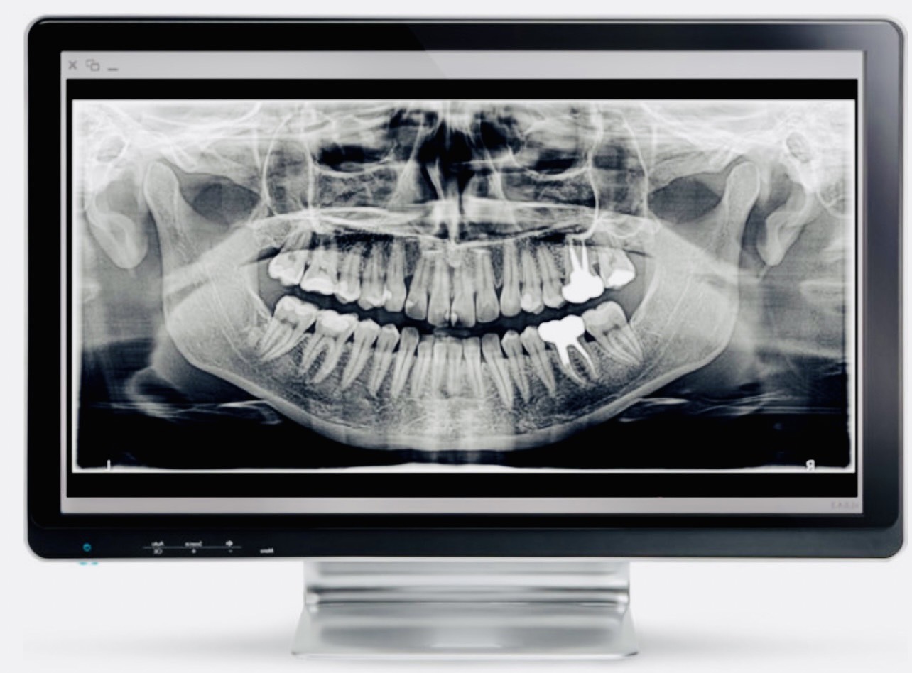 佐賀市の歯医者、池田歯科こども歯科で歯周病治療