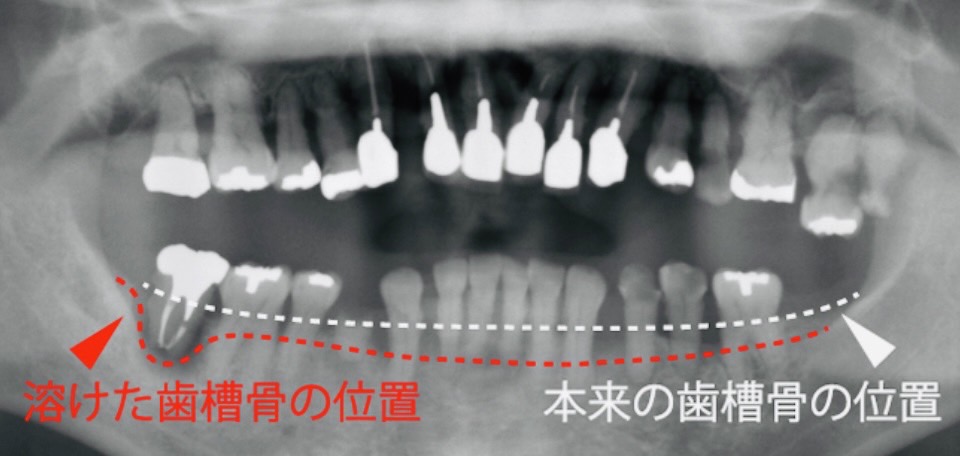 佐賀市の歯医者、池田歯科こども歯科で歯周病治療