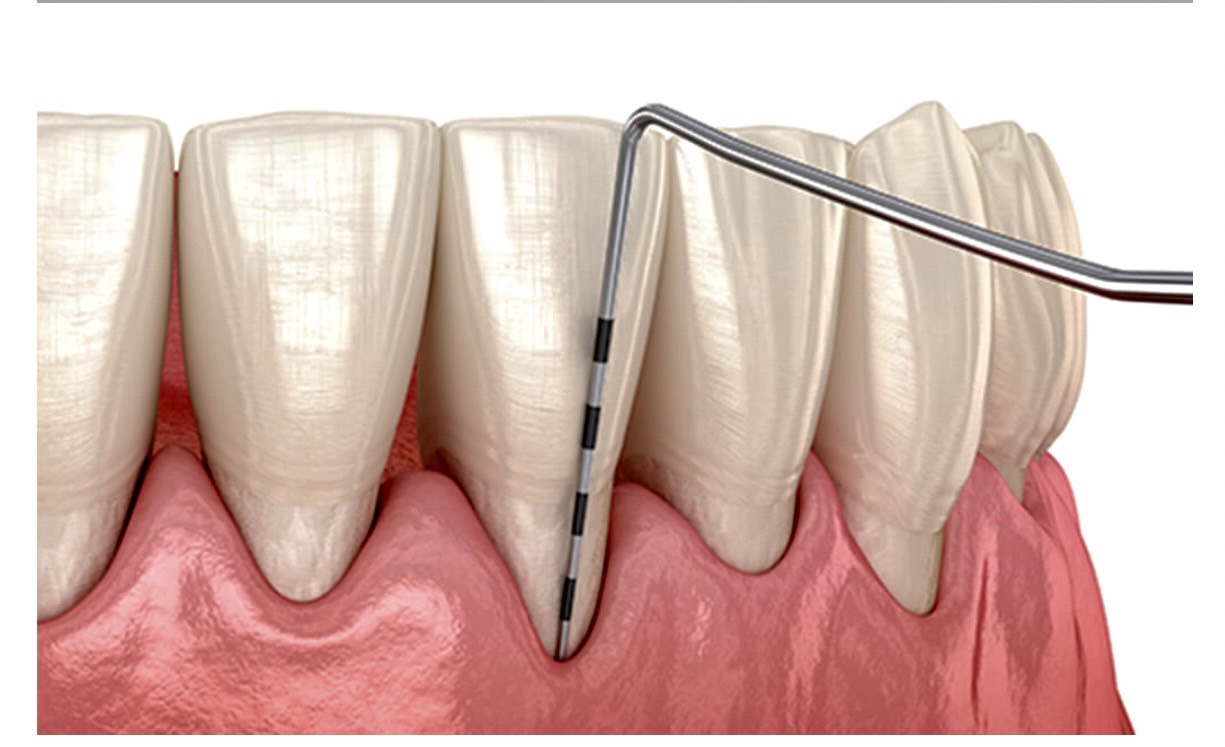 佐賀市の歯医者、池田歯科こども歯科で歯周病治療