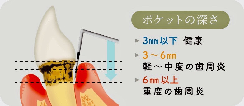 佐賀市の歯医者、池田歯科こども歯科で歯周病治療