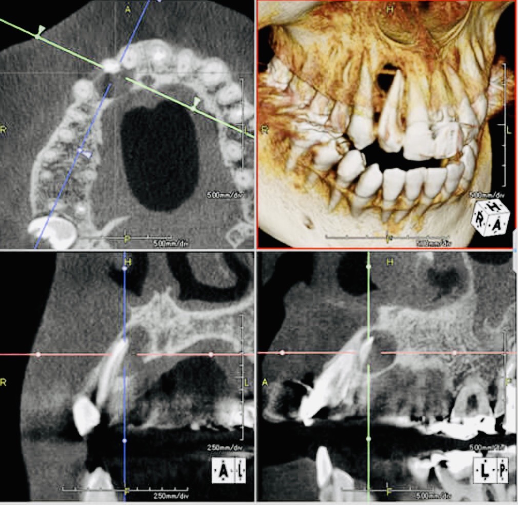 佐賀市の歯医者、池田歯科こども歯科で歯周病治療