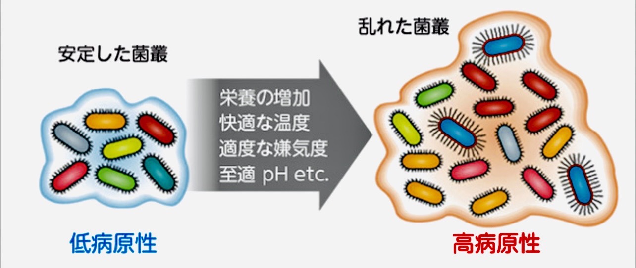 佐賀市の歯医者、池田歯科こども歯科で歯周病治療
