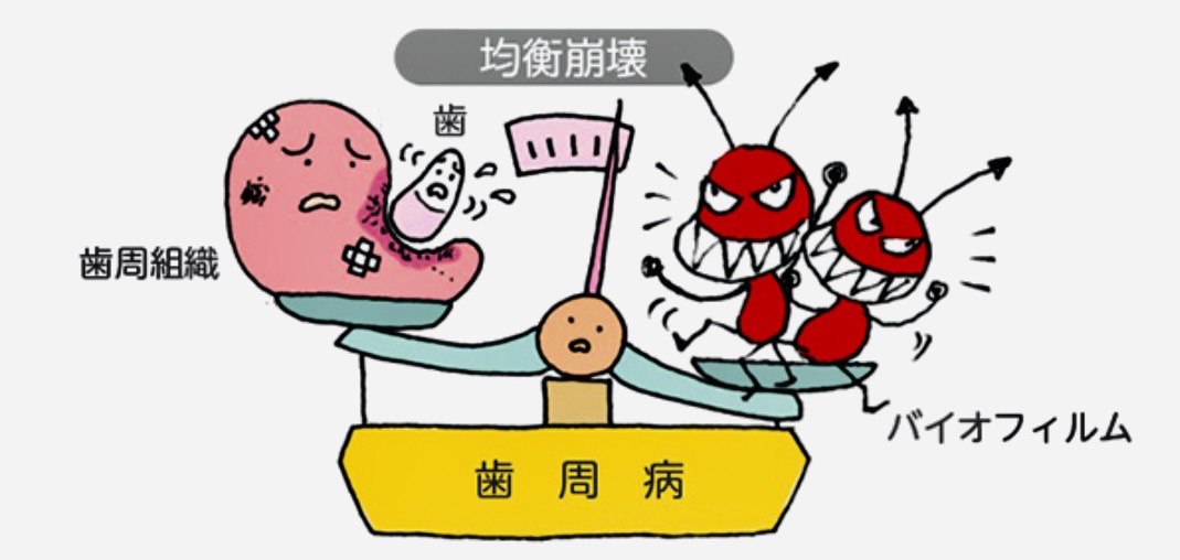 佐賀市の歯医者、池田歯科こども歯科で歯周病治療