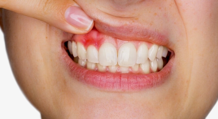 佐賀市の歯医者、池田歯科こども歯科で歯周病治療