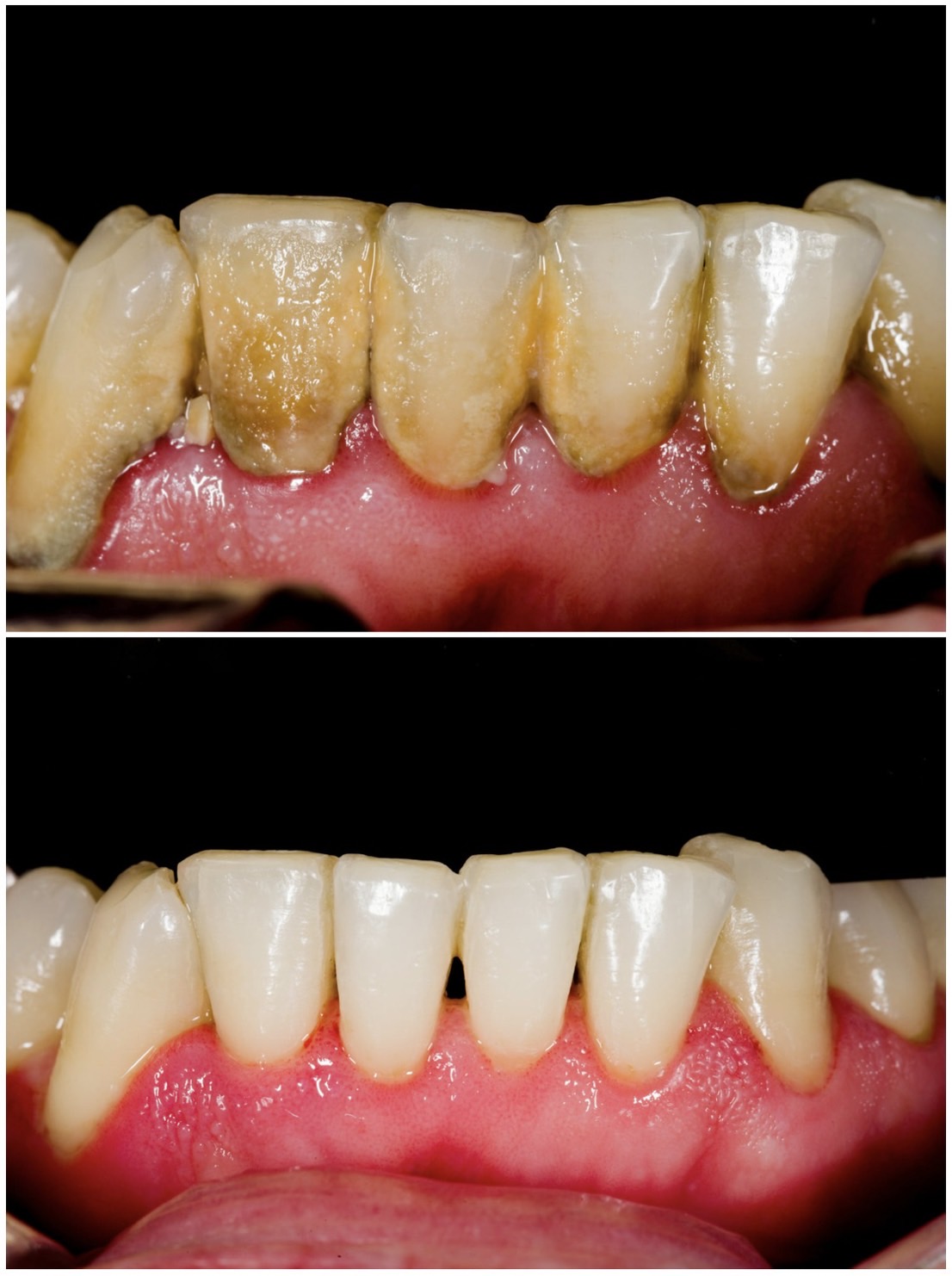 佐賀市の歯医者、池田歯科こども歯科で歯周病治療