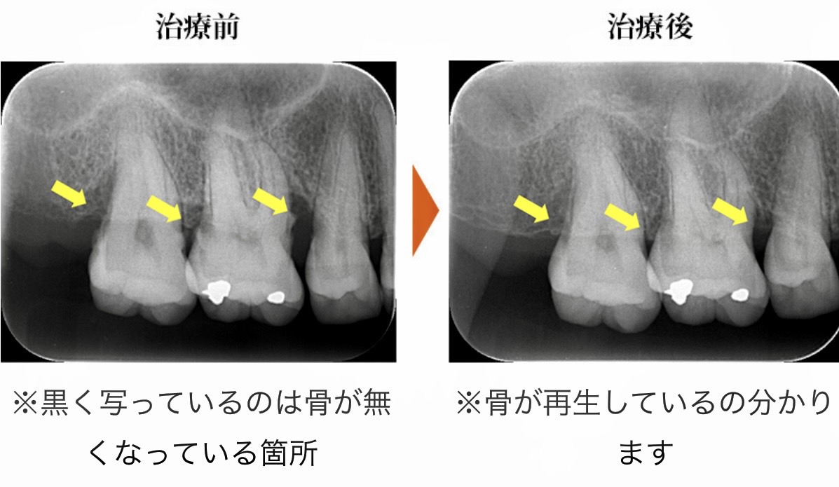 佐賀市の歯医者、池田歯科こども歯科で歯周病治療