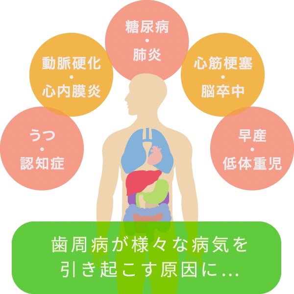 佐賀市の歯医者、池田歯科こども歯科で歯周病治療