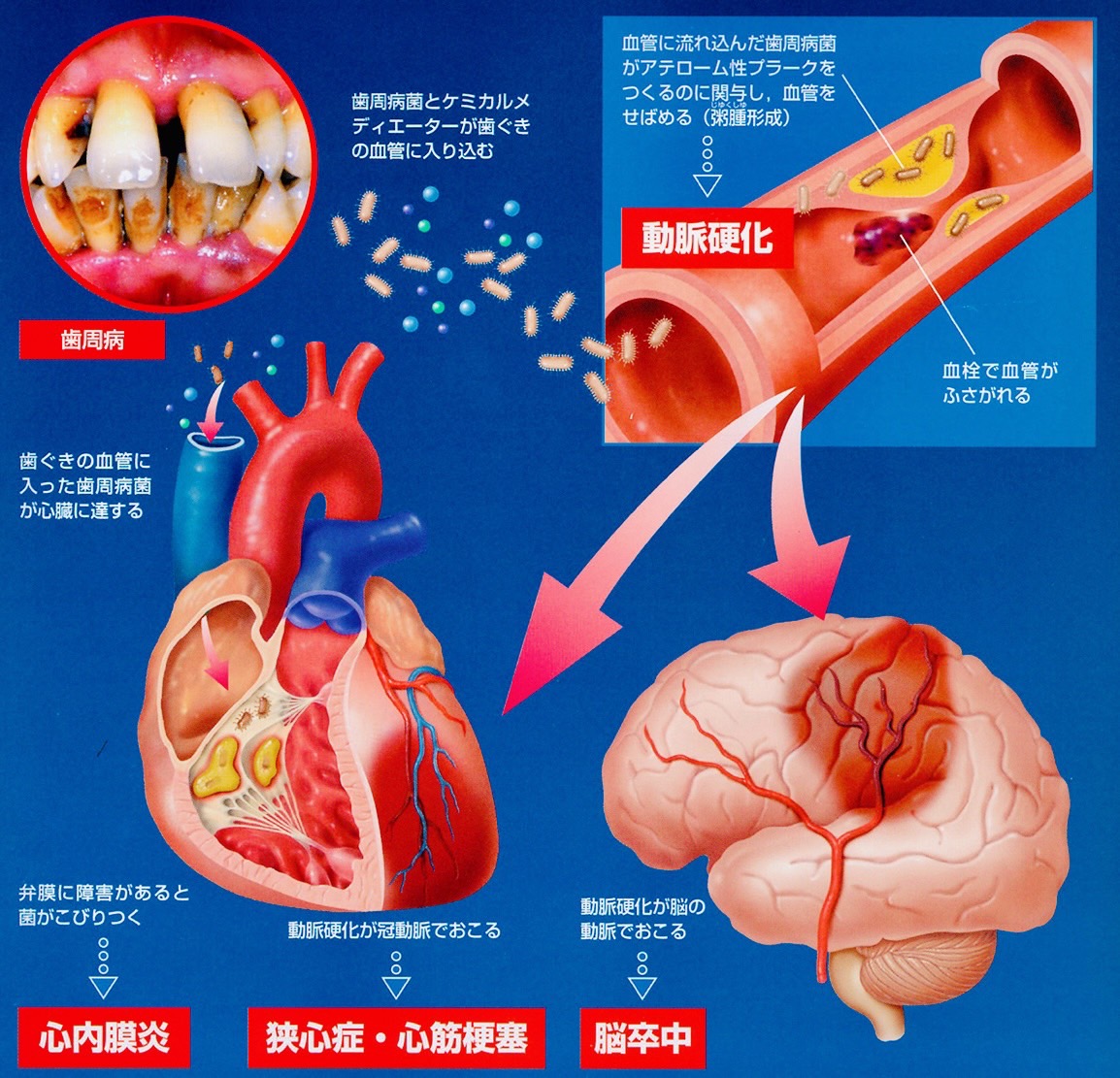 佐賀市の歯医者、池田歯科こども歯科で歯周病治療