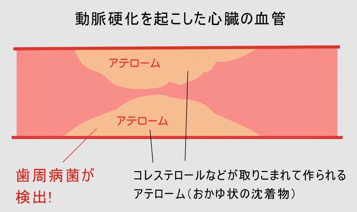 佐賀市の歯医者、池田歯科こども歯科で歯周病治療