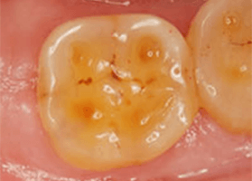 佐賀市の歯医者、池田歯科こども歯科で歯ぎしりの治療