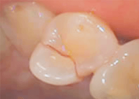 佐賀市の歯医者、池田歯科こども歯科で歯ぎしりの治療