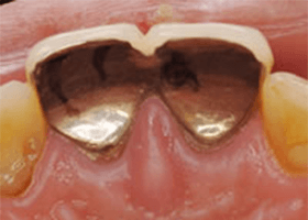 佐賀市の歯医者、池田歯科こども歯科で歯ぎしりの治療