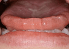 佐賀市の歯医者、池田歯科こども歯科で歯ぎしりの治療