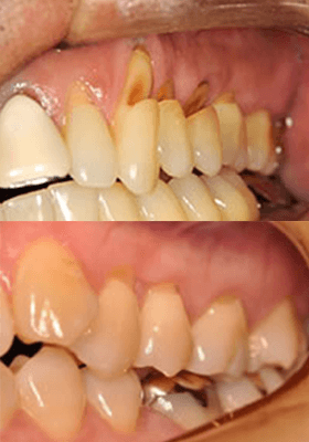 佐賀市の歯医者、池田歯科こども歯科で歯ぎしりの治療