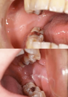 佐賀市の歯医者、池田歯科こども歯科で歯ぎしりの治療