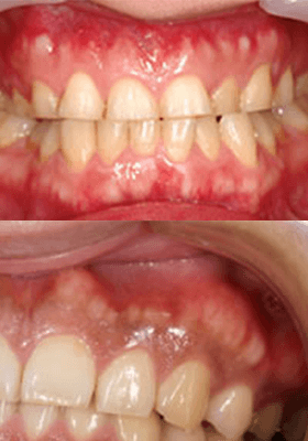 佐賀市の歯医者、池田歯科こども歯科で歯ぎしりの治療