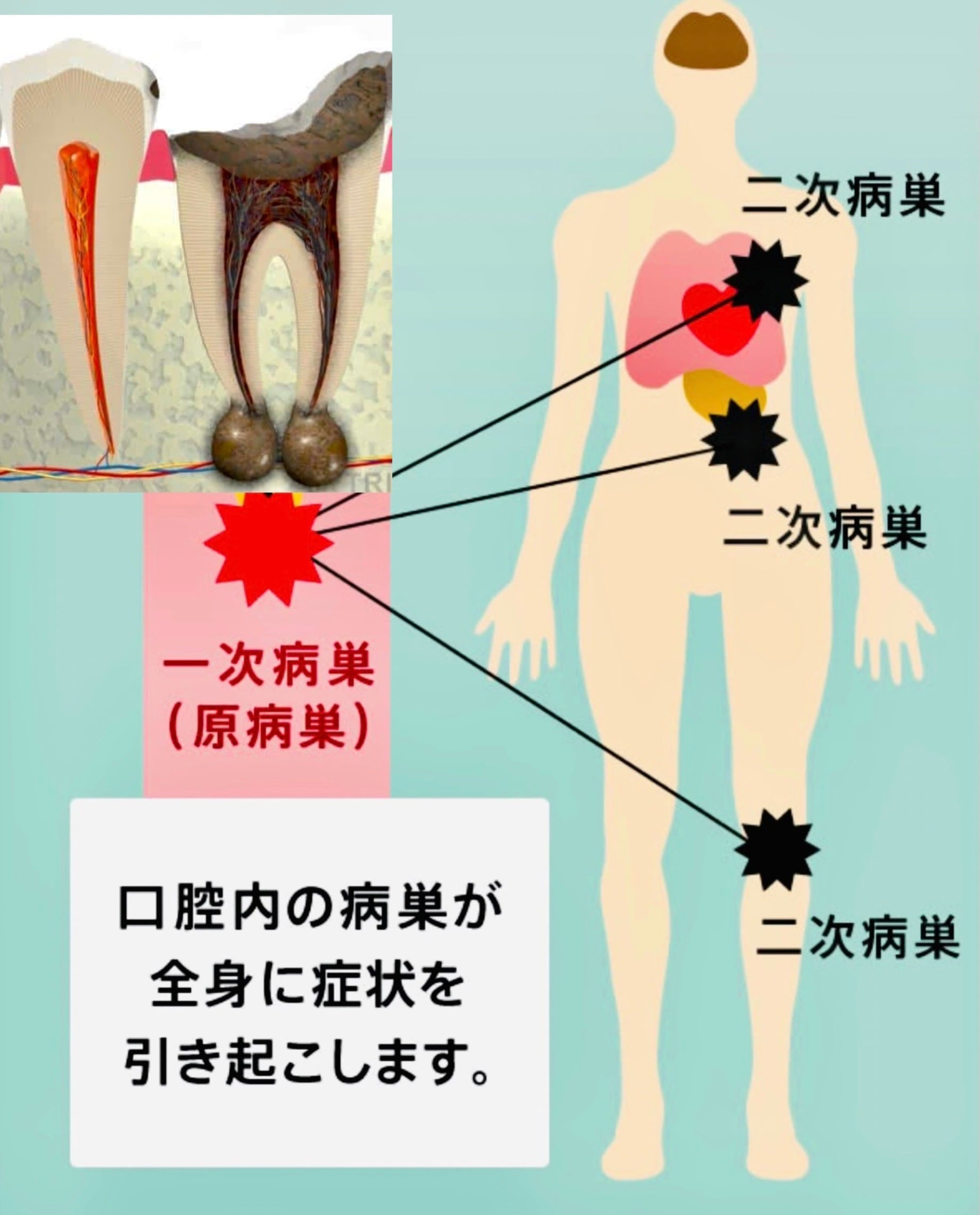 佐賀市の歯医者、池田歯科こども歯科でむし歯治療