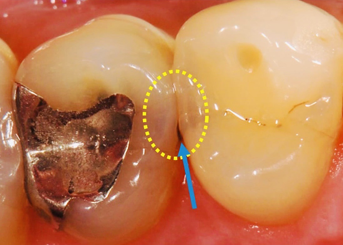 佐賀市の歯医者、池田歯科こども歯科でむし歯治療