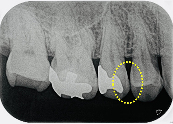佐賀市の歯医者、池田歯科こども歯科でむし歯治療