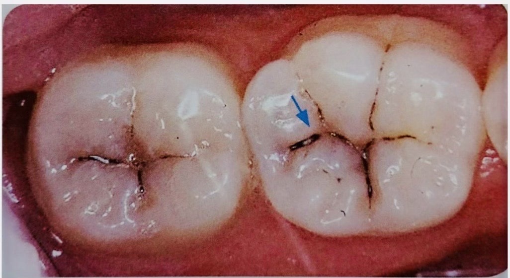 佐賀市の歯医者、池田歯科こども歯科でむし歯治療