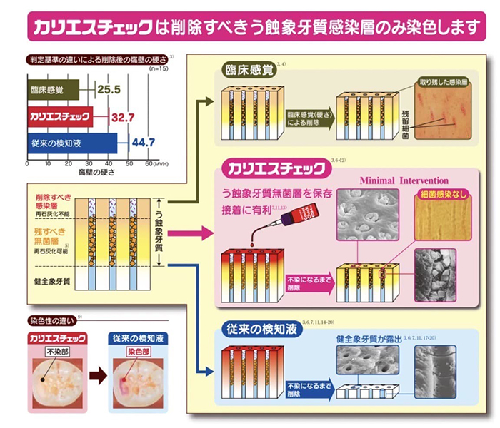 佐賀市の歯医者、池田歯科こども歯科でむし歯治療
