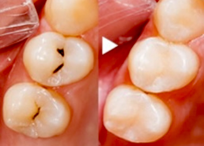 佐賀市の歯医者、池田歯科こども歯科でむし歯治療