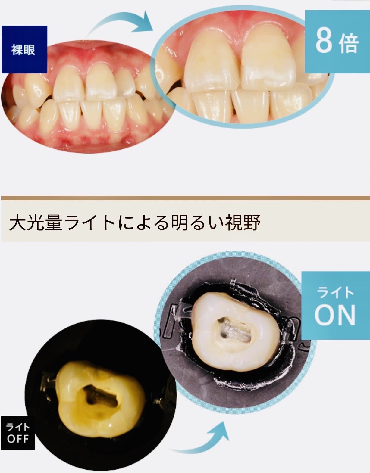 佐賀市の歯医者、池田歯科こども歯科でむし歯治療