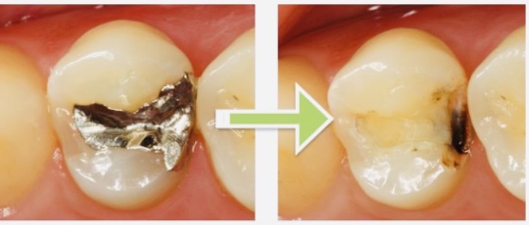 佐賀市の歯医者、池田歯科こども歯科でむし歯治療