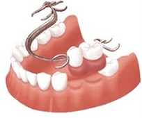 佐賀市の歯医者、池田歯科こども歯科で入れ歯治療