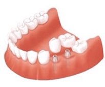 佐賀市の歯医者、池田歯科こども歯科でインプラント治療