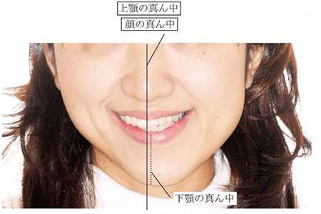 佐賀市の歯医者、池田歯科こども歯科で入れ歯治療