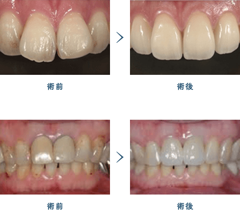 佐賀市の歯医者、池田歯科こども歯科で審美歯科