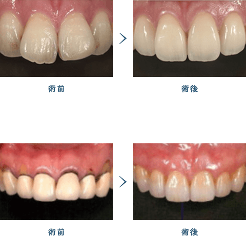 佐賀市の歯医者、池田歯科こども歯科で審美歯科