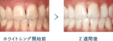 佐賀市の歯医者、池田歯科こども歯科で審美歯科