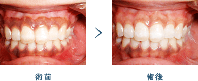 佐賀市の歯医者、池田歯科こども歯科で審美歯科