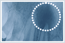 佐賀市の歯医者、池田歯科こども歯科で精密根管治療