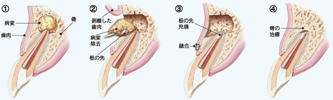 佐賀市の歯医者、池田歯科こども歯科で精密根管治療