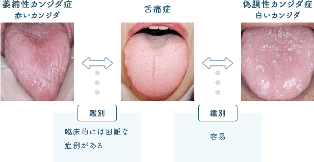 佐賀市の歯医者、池田歯科こども歯科で舌痛症の治療