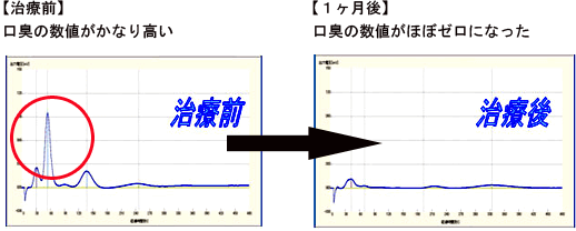 佐賀市の歯医者、池田歯科こども歯科の口臭専門外来