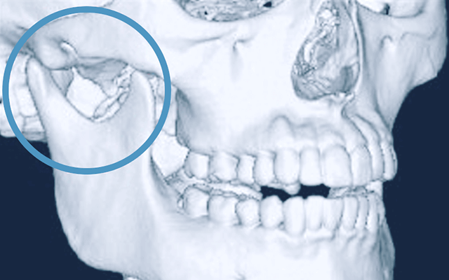 佐賀市の歯医者、池田歯科こども歯科で顎関節症の治療
