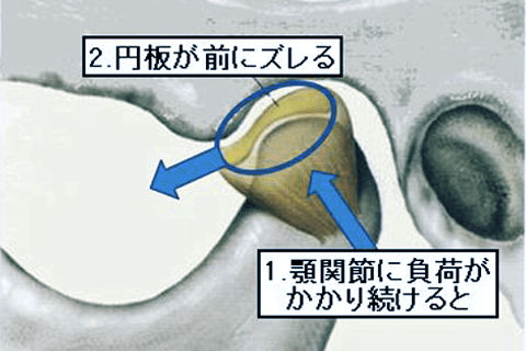 佐賀市の歯医者、池田歯科こども歯科で顎関節症の治療
